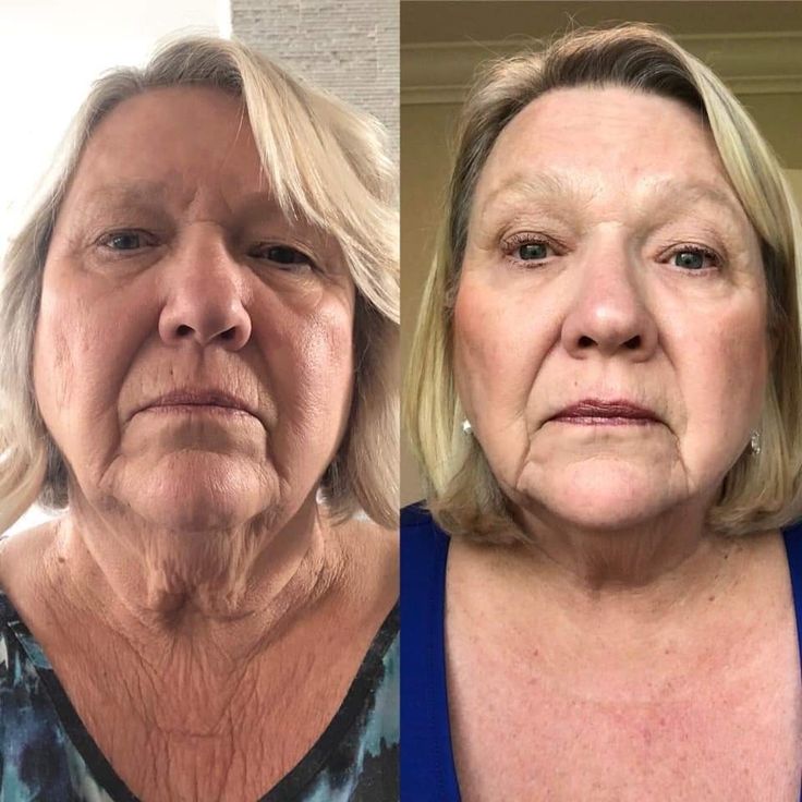 Glovia 7-Color LED Face & Neck Therapy Mask